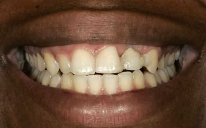 Smile Makeover Stacy - Before