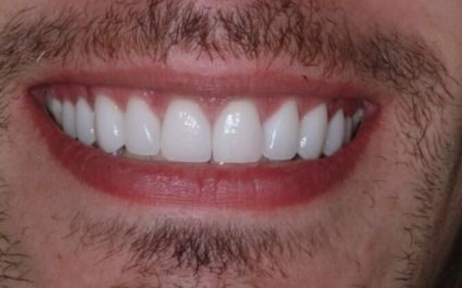 Veneers Vincent - After