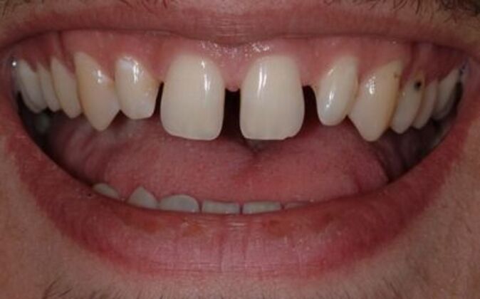 Veneers Vincent - Before