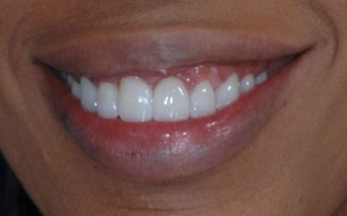 Smile Makeover Aja - After