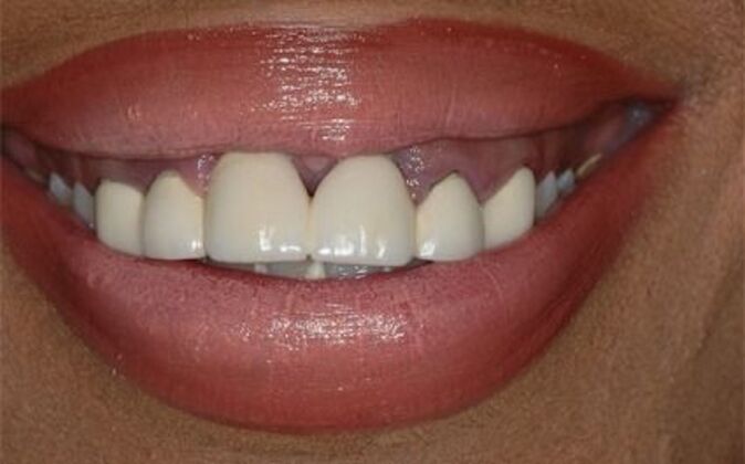 Smile Makeover Aja - Before