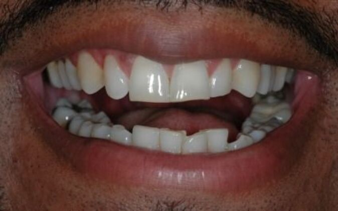 Veneers Dale - Before