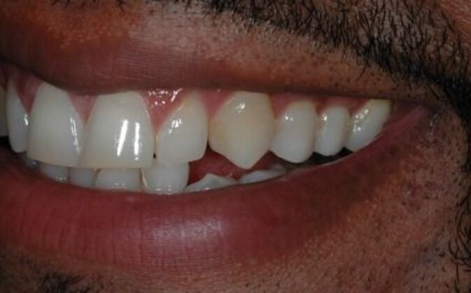 Veneers: Dale - Before