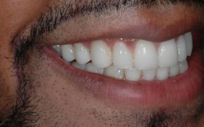 Veneers Dale - After