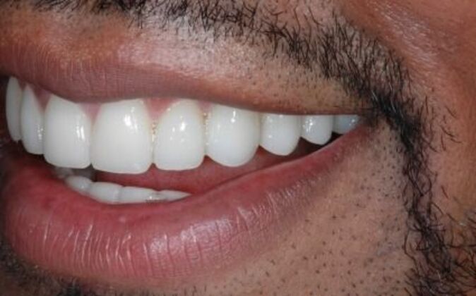 Veneers: Dale - After