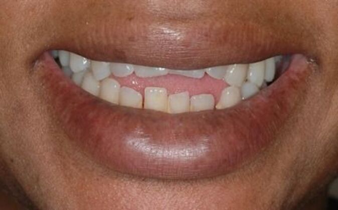 Dental Bridge Tracy - Before