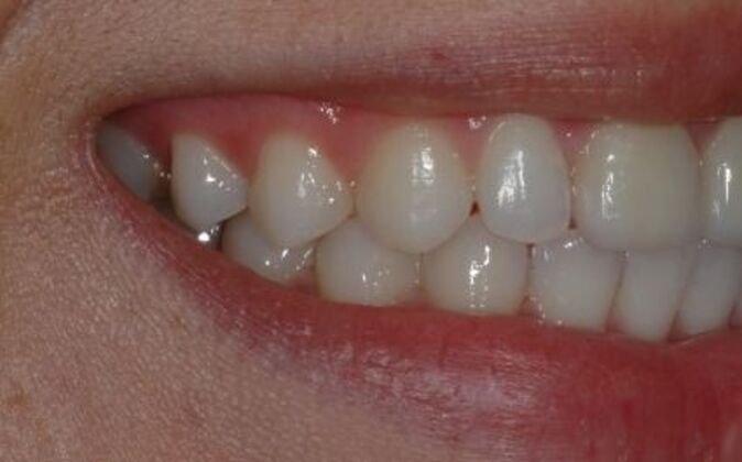 Smile Makeover: Kathy - Before