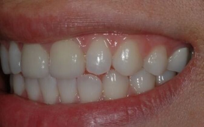 Smile Makeover: Kathy - After