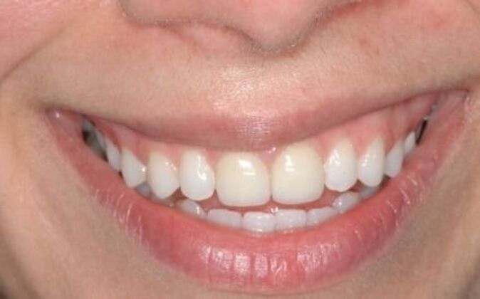 Smile Makeover Kathy - Before