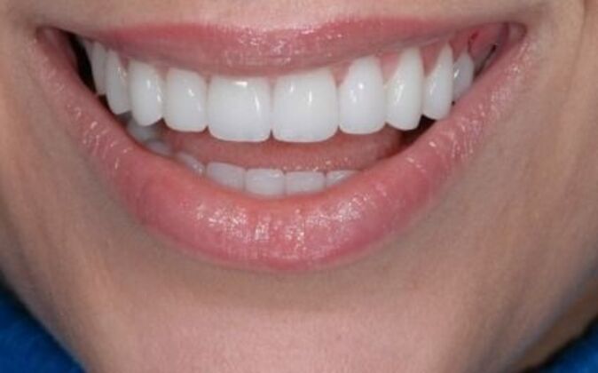 Smile Makeover Kathy - After