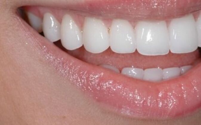 Smile Makeover: Kathy - After