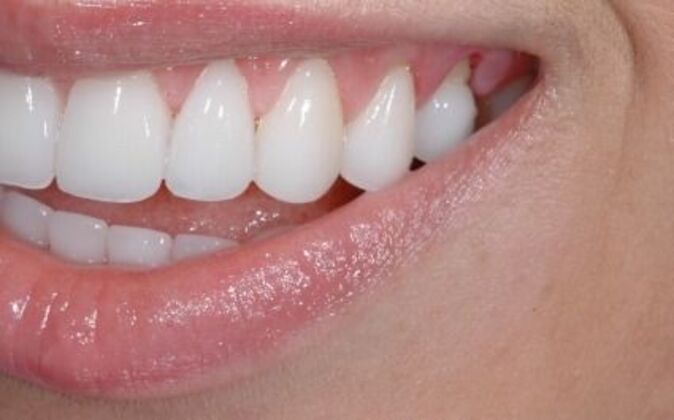 Smile Makeover: Kathy - Before