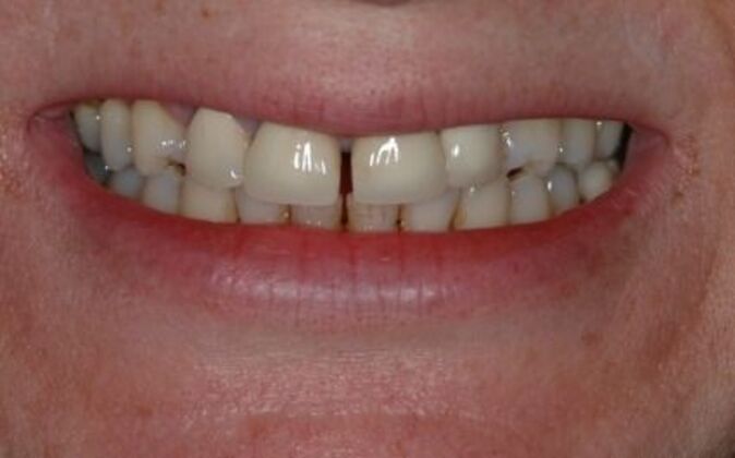 Dental Crowns  Nurten - Before