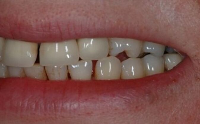 Dental Crowns : Nurten - Before