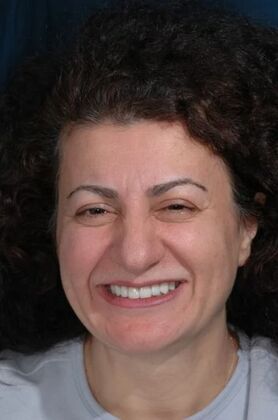 Dental Crowns : Nurten - After