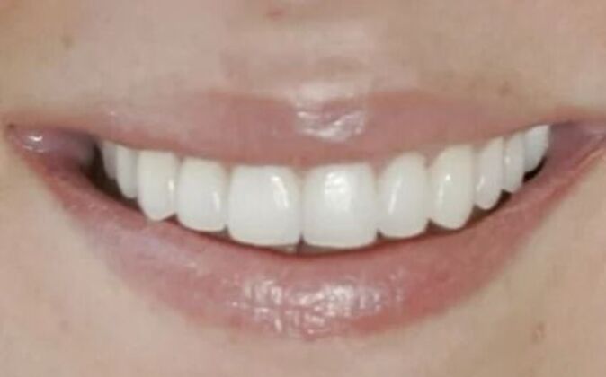 Veneers Rebecca - After