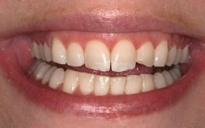 Veneers Rebecca - Before