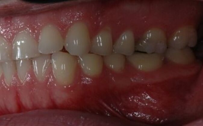 Full Mouth Reconstruction: Saif - After