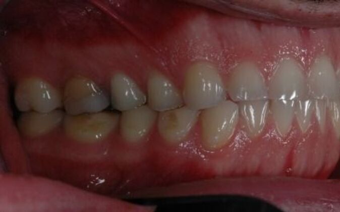 Full Mouth Reconstruction: Saif - Before