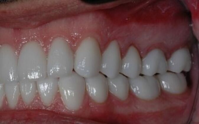 Full Mouth Reconstruction: Saif - Before