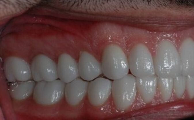 Full Mouth Reconstruction: Saif - After