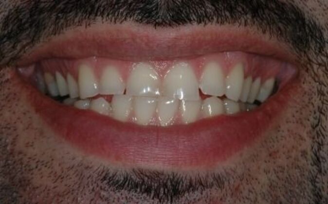 Full Mouth Reconstruction Saif - Before