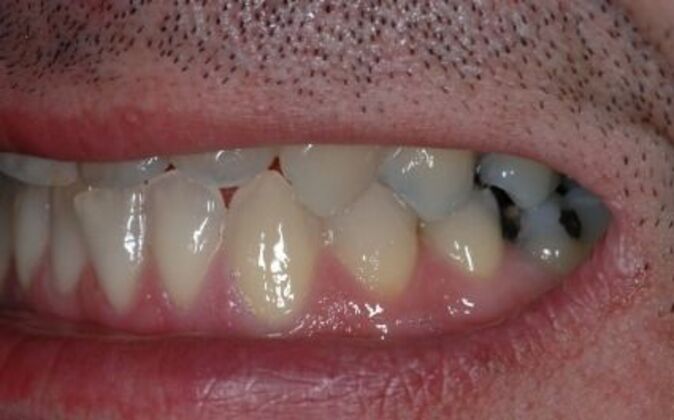 Smile Makeover: Nick 2 - Before