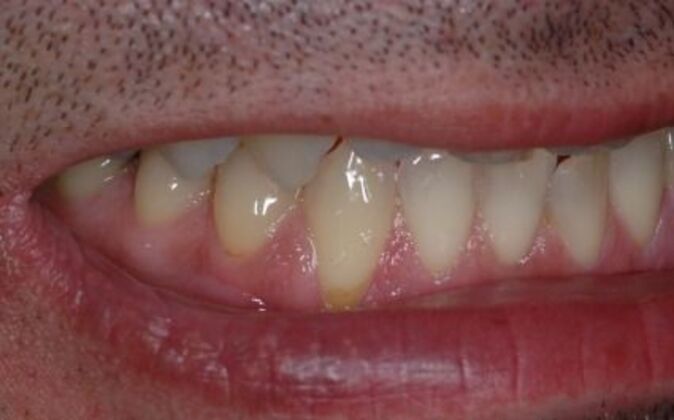 Smile Makeover: Nick 2 - Before