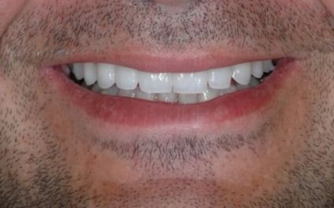 Smile Makeover Nick 2 - After