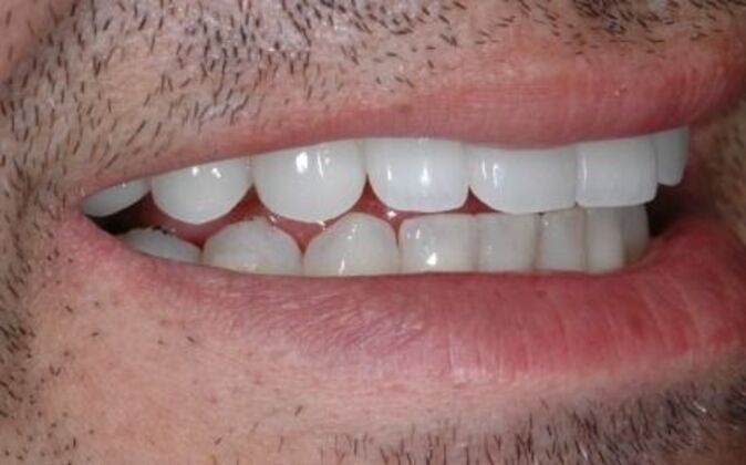 Smile Makeover: Nick 2 - After