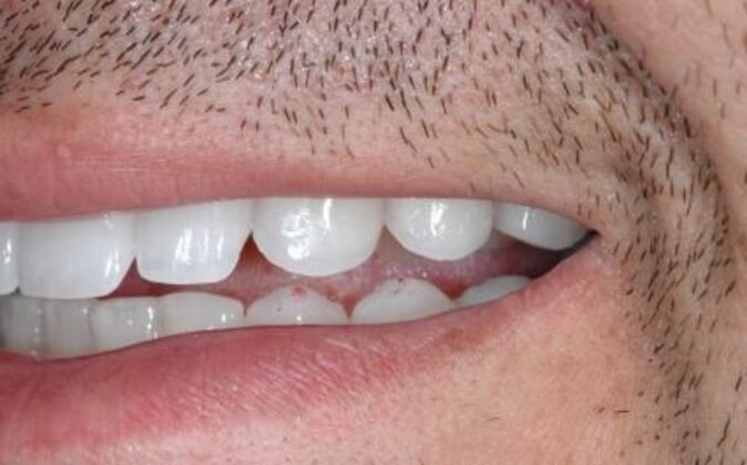 Smile Makeover: Nick 2 - After