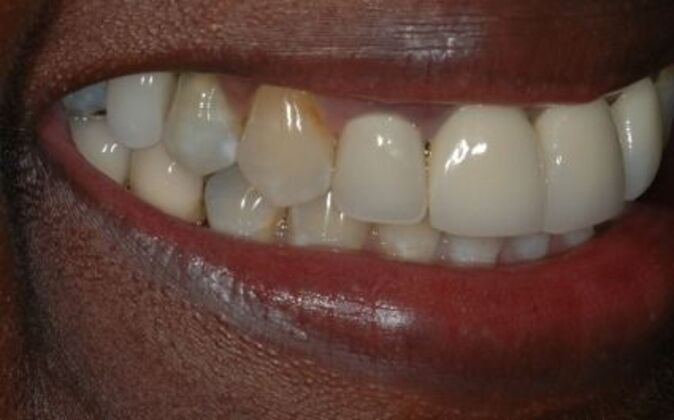 Full Mouth Reconstruction: Wariara - Before