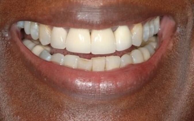 Full Mouth Reconstruction Wariara - Before