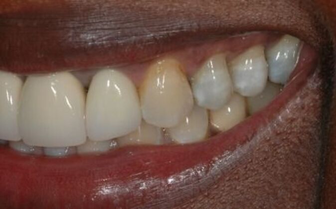 Full Mouth Reconstruction: Wariara - Before