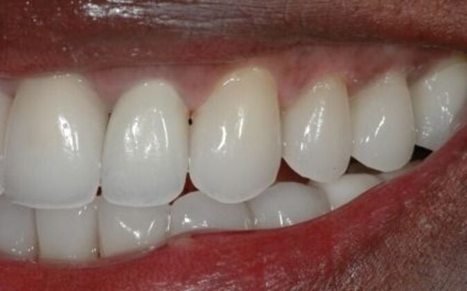 Full Mouth Reconstruction: Wariara - After