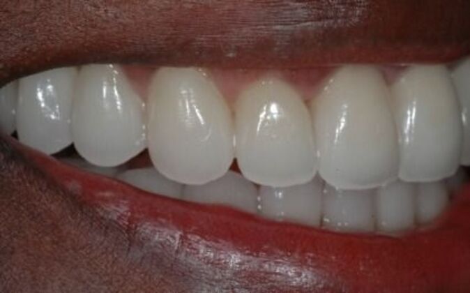 Full Mouth Reconstruction: Wariara - After