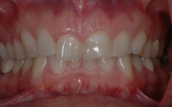 Full Mouth Reconstruction: Jen - Before