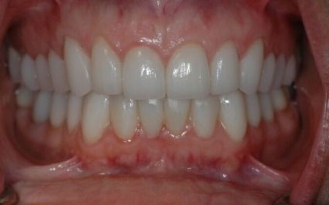 Full Mouth Reconstruction: Jen - After