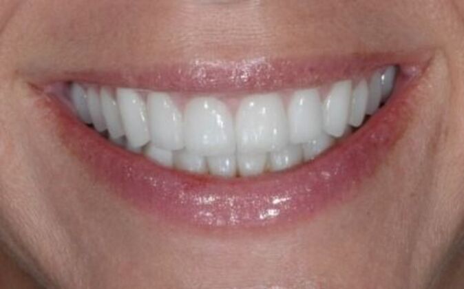 Full Mouth Reconstruction Jen - After