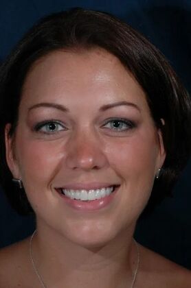 Dental Crowns : Liz - After