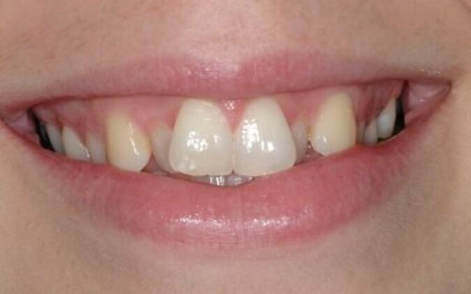 Dental Crowns  Liz - Before