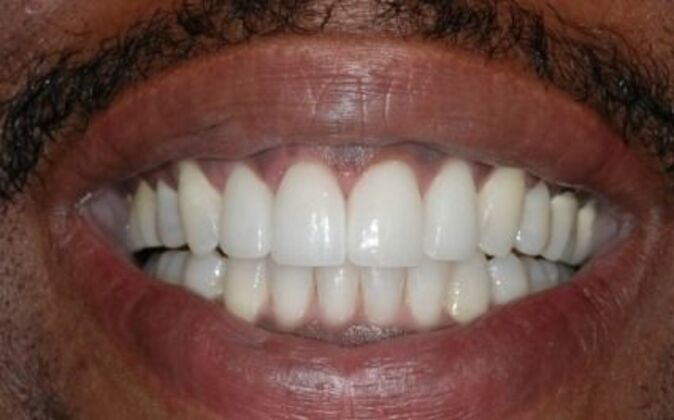 Smile Makeover Chuck - After