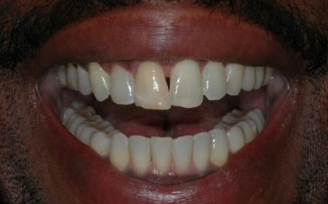 Smile Makeover Chuck - Before