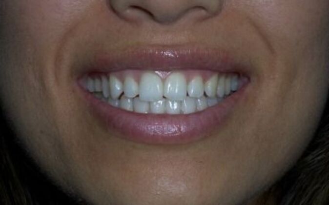 Veneers Daniela - Before