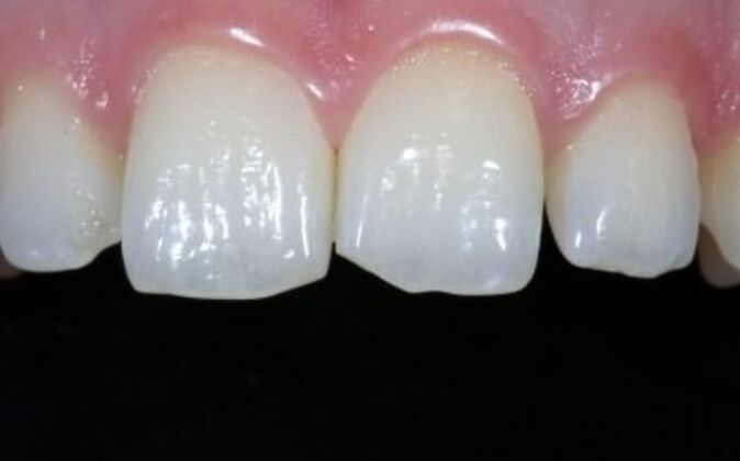 Veneers: Daniela - Before