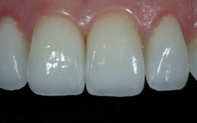 Veneers: Daniela - After
