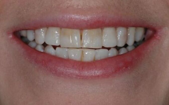 Veneers Yvonne - Before