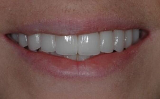 Veneers Yvonne - After
