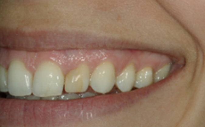 Veneers Katherine - Before