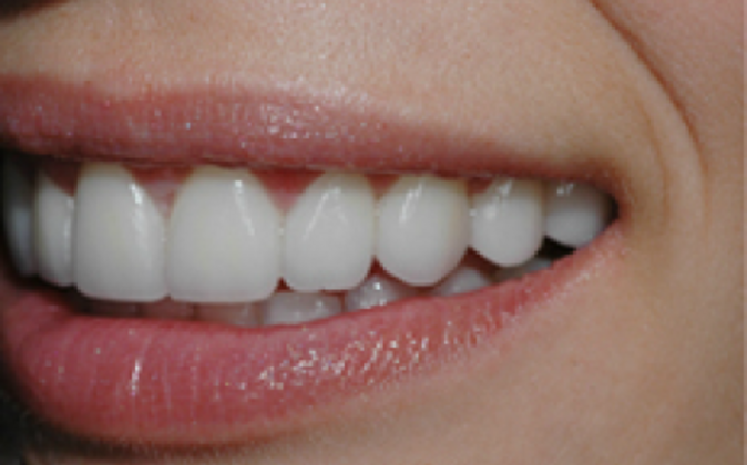 Veneers Katherine - After